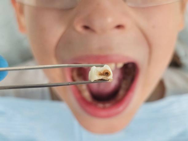 Best Pediatric Emergency Dentist in Bourbon, IN