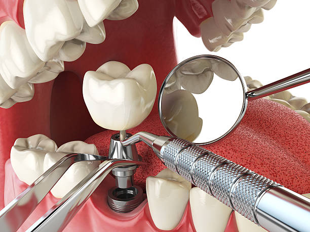 Best Emergency Wisdom Teeth Removal in Bourbon, IN